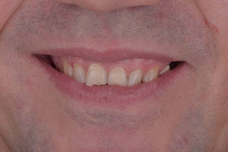 Gummy smile